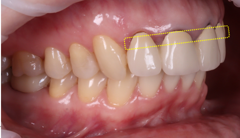 신논현치과 외국인 까만 앞니 크라운 교체 사례 관련 이미지 8
