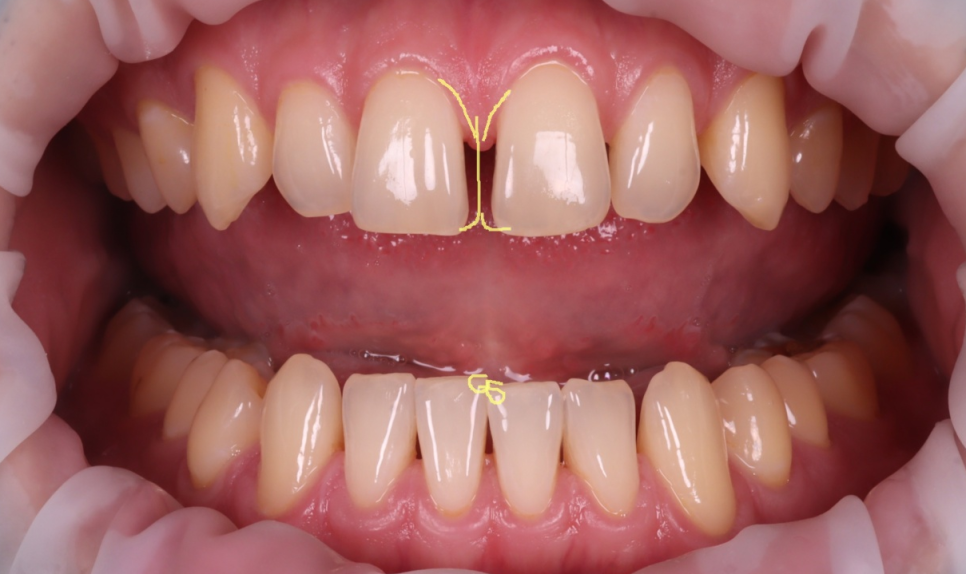 서울치과 앞니 레진 전 이걸 먼저 확인해야 돼요 관련 이미지 6