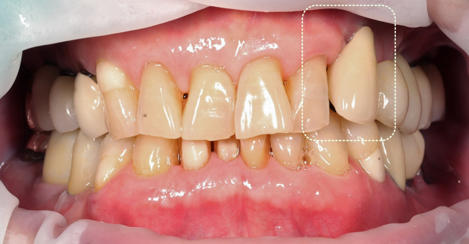 선릉역치과 타원 앞니 임플란트 빼고 재수술 해드린 이유 관련 이미지 3