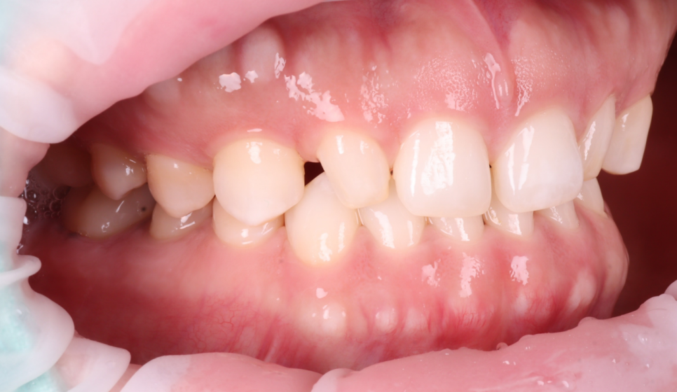 앞니 왜소치 레진 치과의사 소개로 내원해 당일 완료 관련 이미지 7