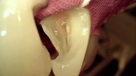 잘못된 앞니 레진 뼈까지 녹인다? 레진 재치료 과정 관련 이미지 10