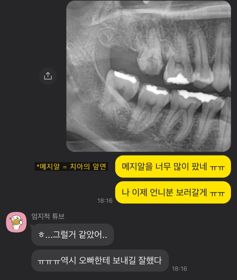 동기 치과의사의 부탁으로 어금니 신경치료만 마무리 해드린 케이스 관련 이미지 3