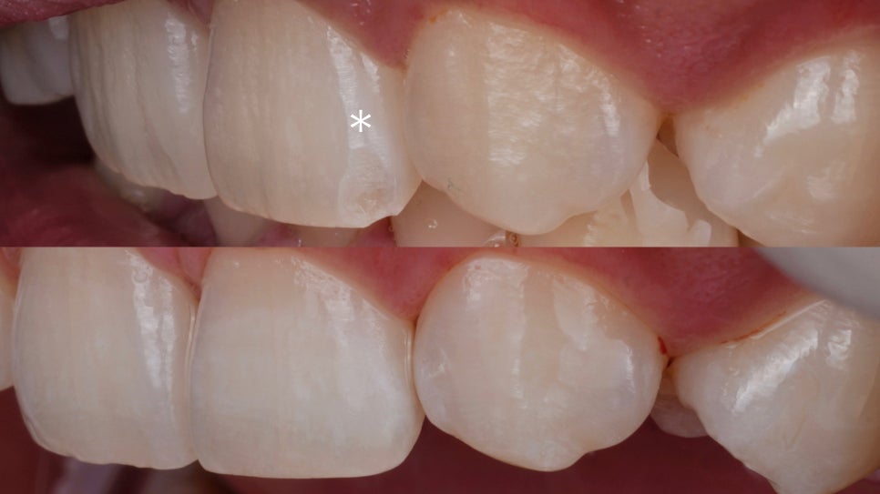 앞니 깨짐, 레진으로 감쪽같이 복원하는 방법 관련 이미지 3