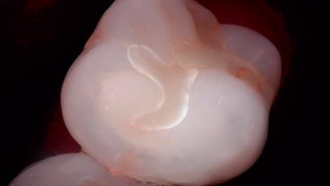 교대역 치과 보철 아래 2차 충치를 다시 레진으로 관련 이미지 12