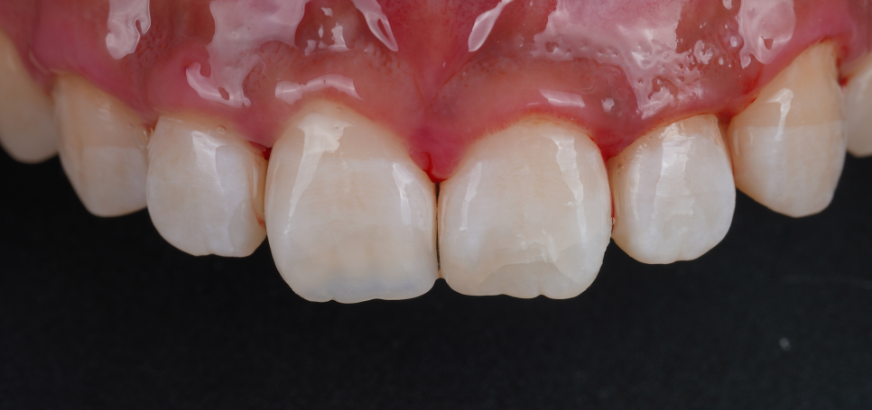 반포동치과 앞니 깨짐 레진 삭제 없이 당일에 치료 끝 관련 이미지 10