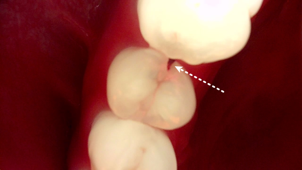 서초역치과 이걸로 신경치료 미뤄드리고 있어요 관련 이미지 3