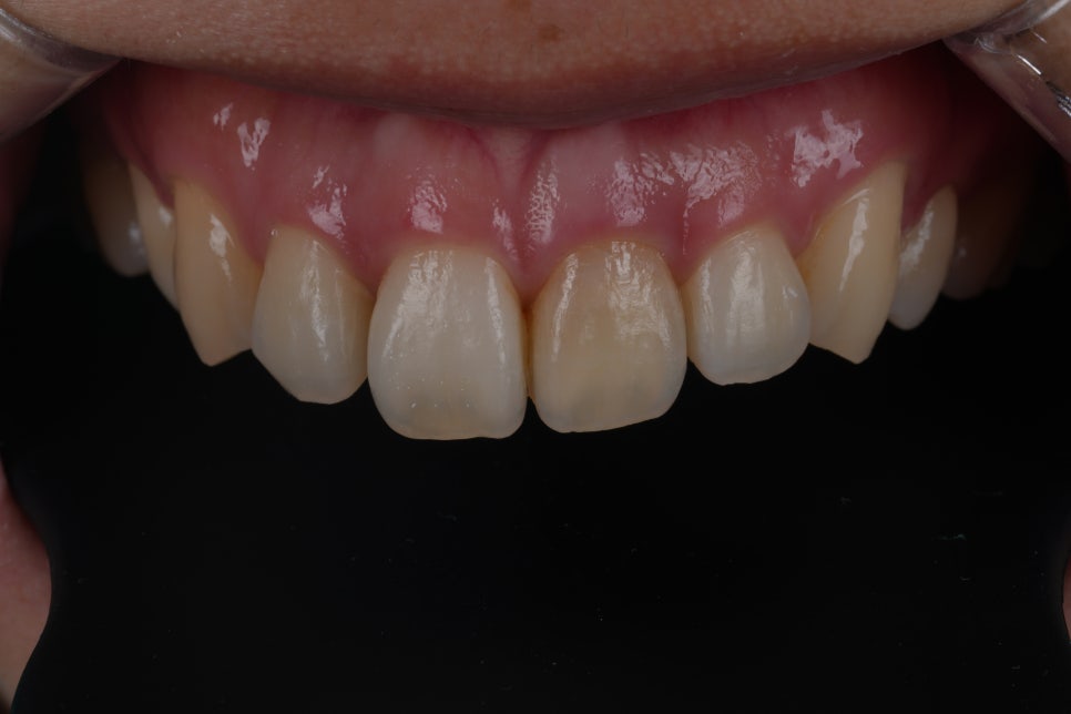 Why Discoloration Did Not Brighten Even After Internal Bleaching at Seoul National University Hospital Station image 1