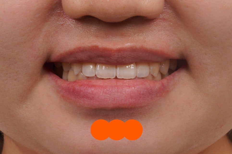 왜소치 레진, 갤럭시네이트 레진비니어로 당일 치료완료 (서초동 치과) 관련 이미지 5