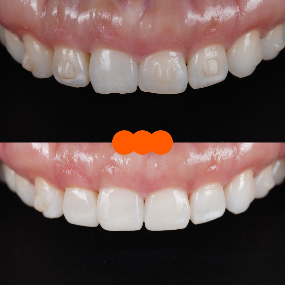 신사역치과 미국에서 교정 중이던 분 앞니 레진으로 고민 해결 관련 이미지 12