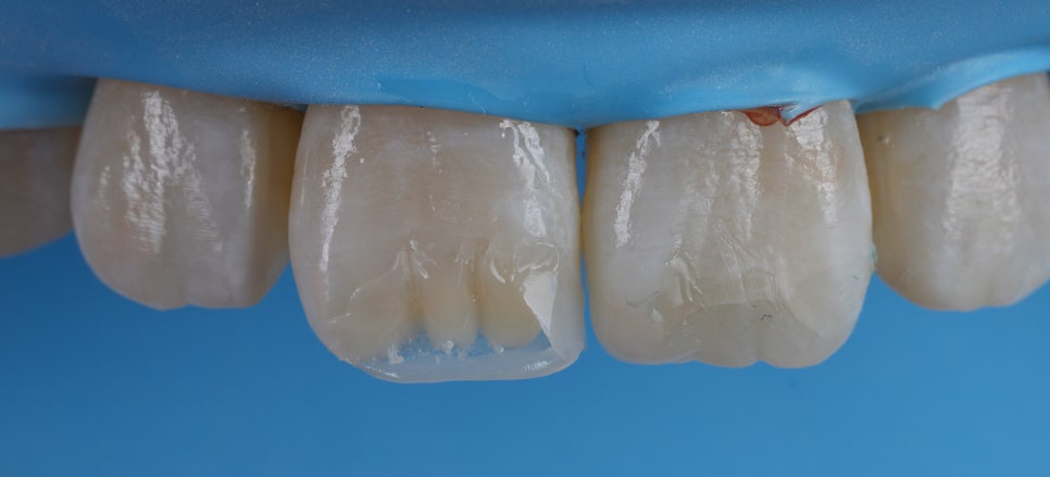 반포동치과 앞니 깨짐 레진 삭제 없이 당일에 치료 끝 관련 이미지 8