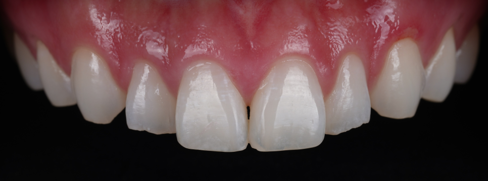 If Your Front Teeth Look Extra Large, Be Sure to Read This — Gyodae Station Dental Clinic image 5