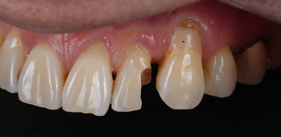 서초구치과 레진 탈락 재치료 2가지가 성공 핵심입니다 관련 이미지 6