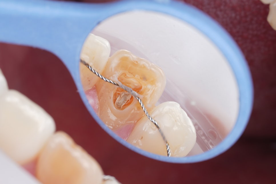 서초치과 5년간 14개 치과 돌다 본원에서 정착한 이유는? 관련 이미지 8