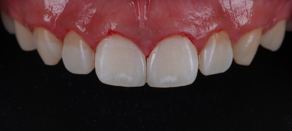 방배동치과 앞니 벌어짐 해결하러 강릉에서 오셨어요 관련 이미지 12