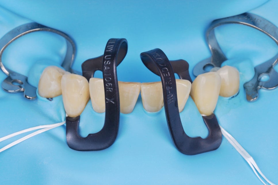 20년 전 때운 레진 떨어짐으로 이 사이 벌어짐 치료 : 교대역 치과에서 당일 레진 관련 이미지 4