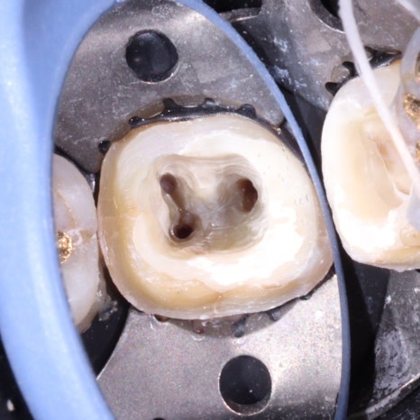 교대역 어금니 크랙 깨짐으로 씹을때 통증, 발치 피하고 신경치료로 유지한 케이스 관련 이미지 5