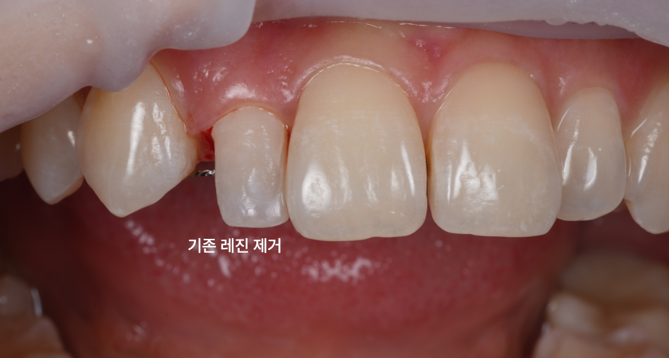 왜소치레진 20년 전에 했던 치아 재치료 후 반대쪽까지 관련 이미지 10