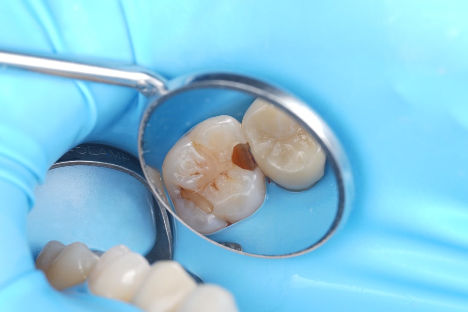 Do Cavities Between Teeth at Sinsa Station Dental Clinic Have to Be Treated with an Inlay? Resin Is Also an Option image 10