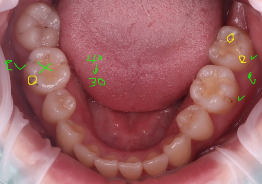 교대역치과 타치과 신경치료, 크라운 진단받았으나 레진으로 치료 관련 이미지 14