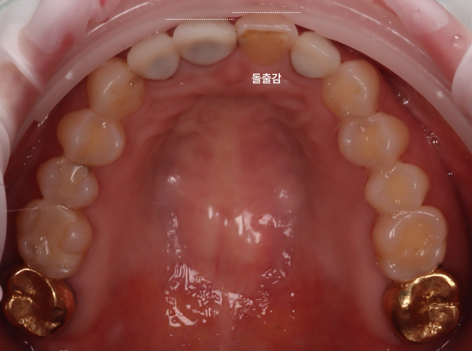 라미네이트, 크라운 재치료, 잇몸 성형까지 앞니 6개 치료 관련 이미지 3