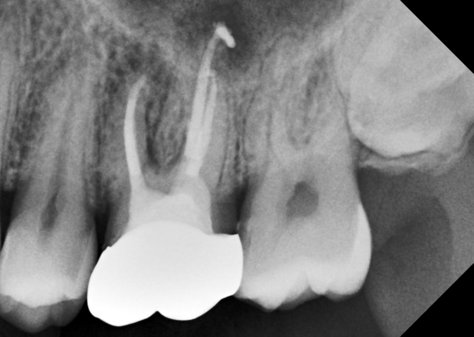 신경치료 후 크라운 씌운 치아 통증, 재신경치료 및 지르코니아 크라운 재치료 관련 이미지 4