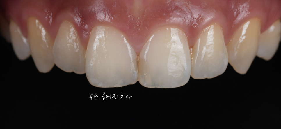 앞니사이충치 레진으로 치아성형 효과까지 낼 수 있어요 관련 이미지 3