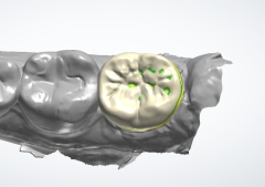 Gangnam Dental Clinic: You Wanted an Extraction, but We Preserved the Tooth with Root Canal Treatment + Overlay image 15