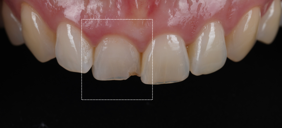 Gangnam Dental Clinic: Resin Restoration Process for a Chipped Front Tooth Considering Tooth Position image 1