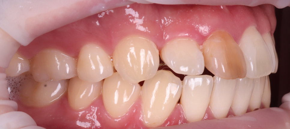 서초치과 5년간 14개 치과 돌다 본원에서 정착한 이유는? 관련 이미지 4