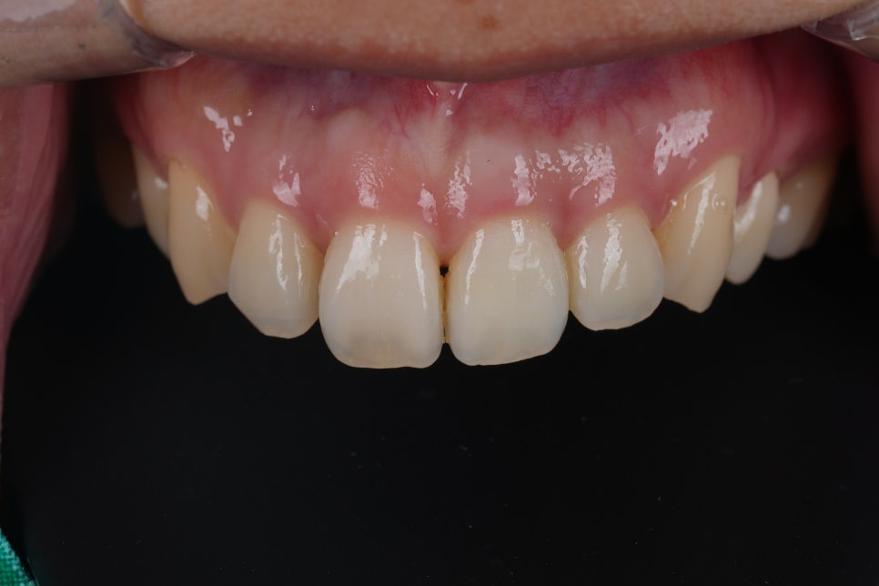 Why Discoloration Did Not Brighten Even After Internal Bleaching at Seoul National University Hospital Station image 2