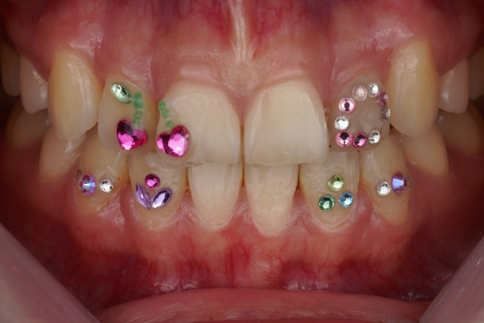 요즘 투스젬 맛집, 근데 이제 제거 맛집인- 투스젬 제거킹 재좋치 관련 이미지 3