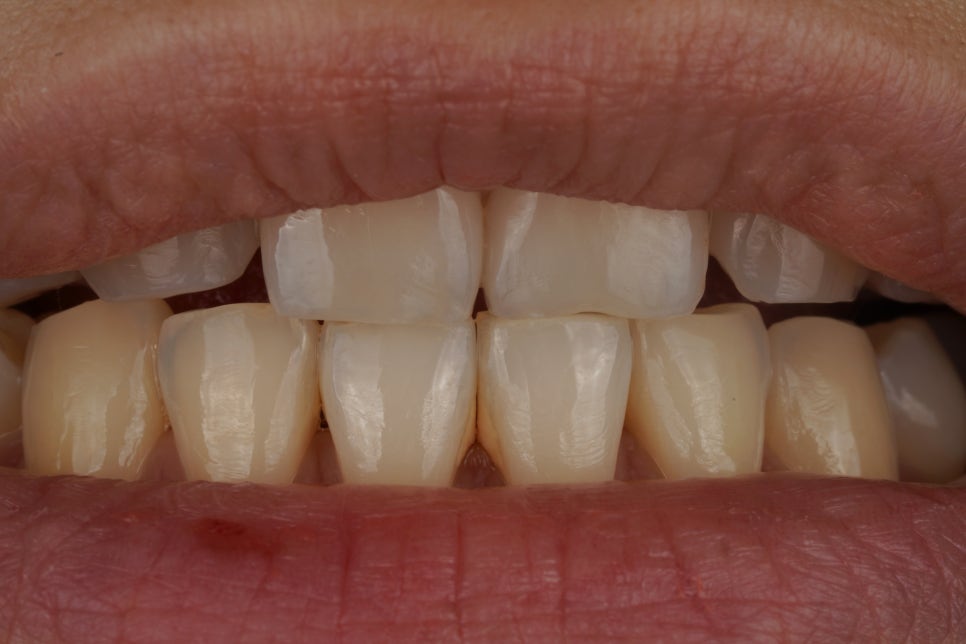 앞니살짝깨짐 치아성형은 역시 교대역 재주좋은 치과 관련 이미지 2