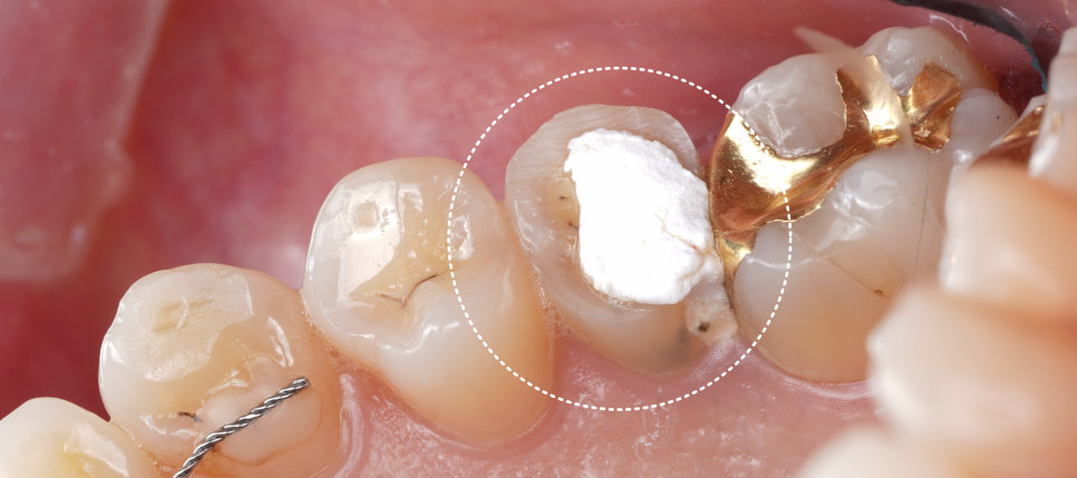 신경치료 후 크라운 안 하고 레진으로 할 수 있어요 관련 이미지 4