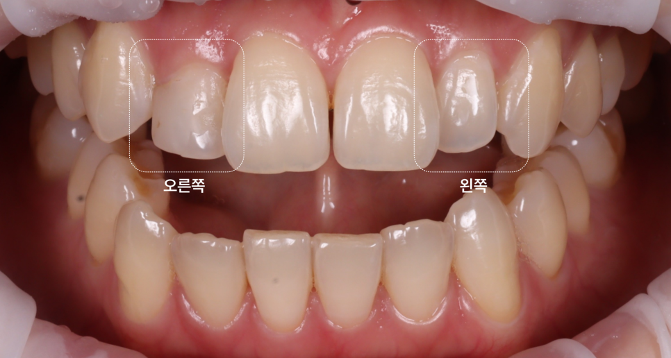 왜소치레진 20년 전에 했던 치아 재치료 후 반대쪽까지 관련 이미지 2