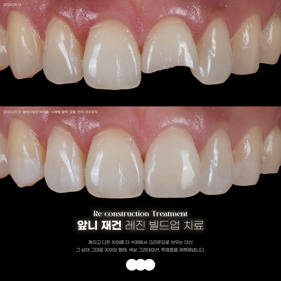 앞니 깨짐 레진 어디서할지 고민될 때 꼭 보세요 관련 이미지 5