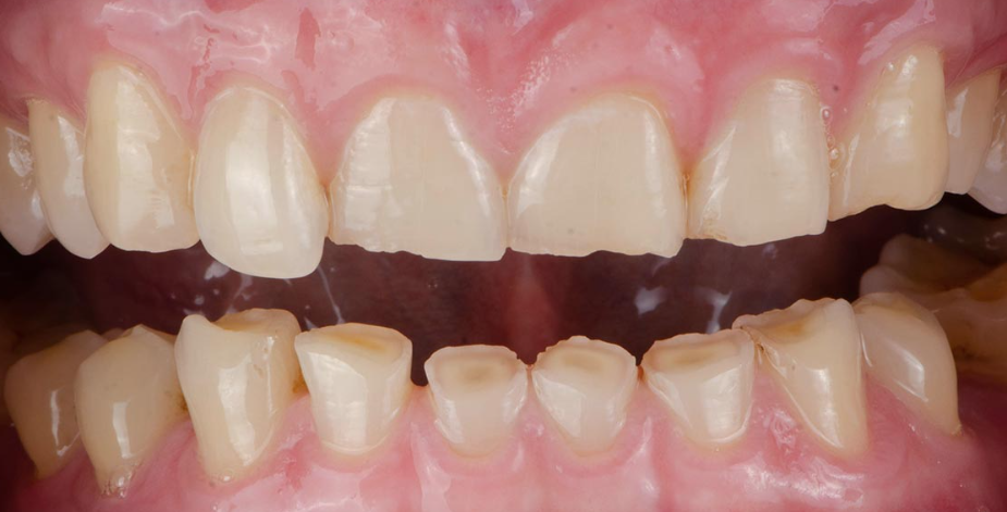 이갈이 장치 보톡스랑 함께 하면 훨씬 좋은 이유 관련 이미지 9