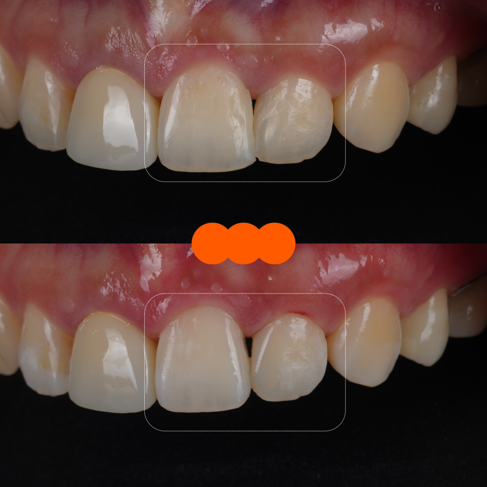 서초동치과 전라도 광주에서 레진 재치료 받으러 오신 사례 관련 이미지 12
