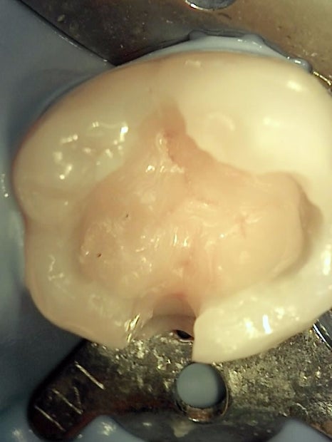 인레이치료 하방 2차 충치 레진 빌드업 사례 관련 이미지 9