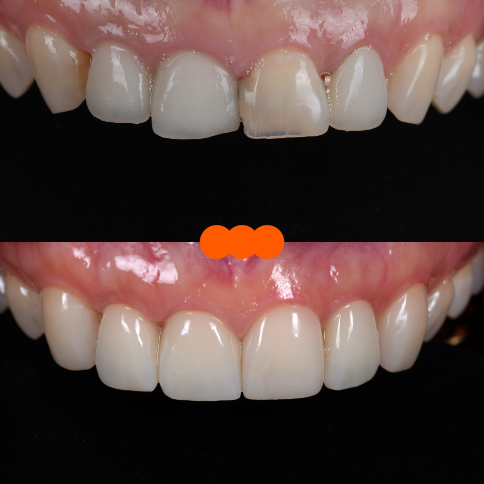 라미네이트, 크라운 재치료, 잇몸 성형까지 앞니 6개 치료 관련 이미지 14