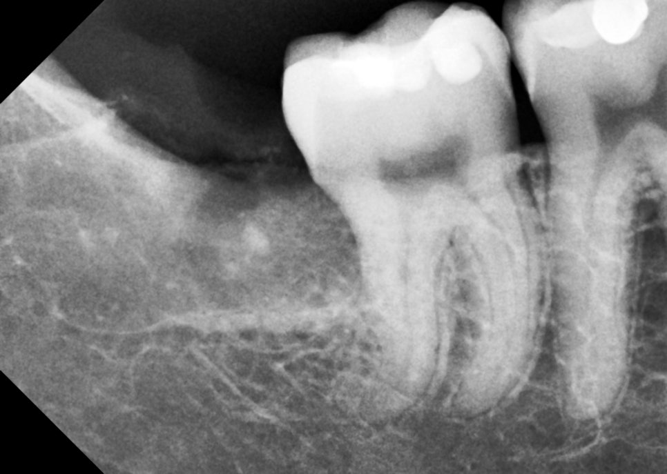 사랑니발치 매복 돼도 이렇게 빼면 안전해요 관련 이미지 13