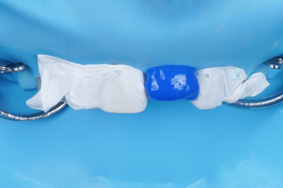 서울 앞니 레진으로 40분 안에 자연스럽게 복원한 케이스 관련 이미지 4