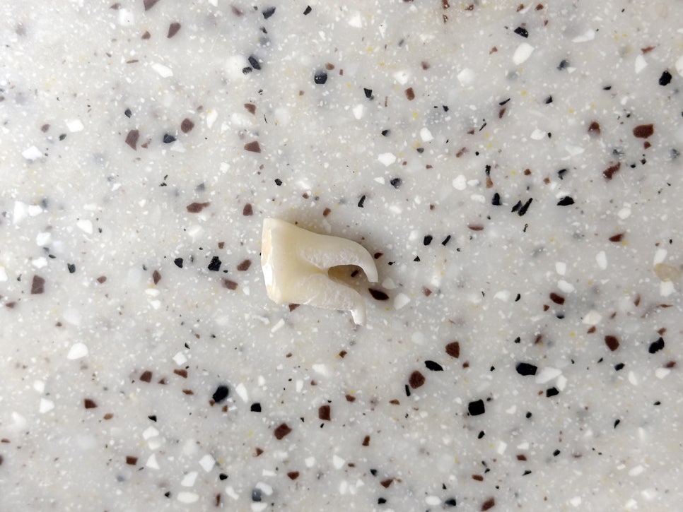 교대역 누운 매복 사랑니 당일 발치, 강남대성 별관에서 온 학생 관련 이미지 4