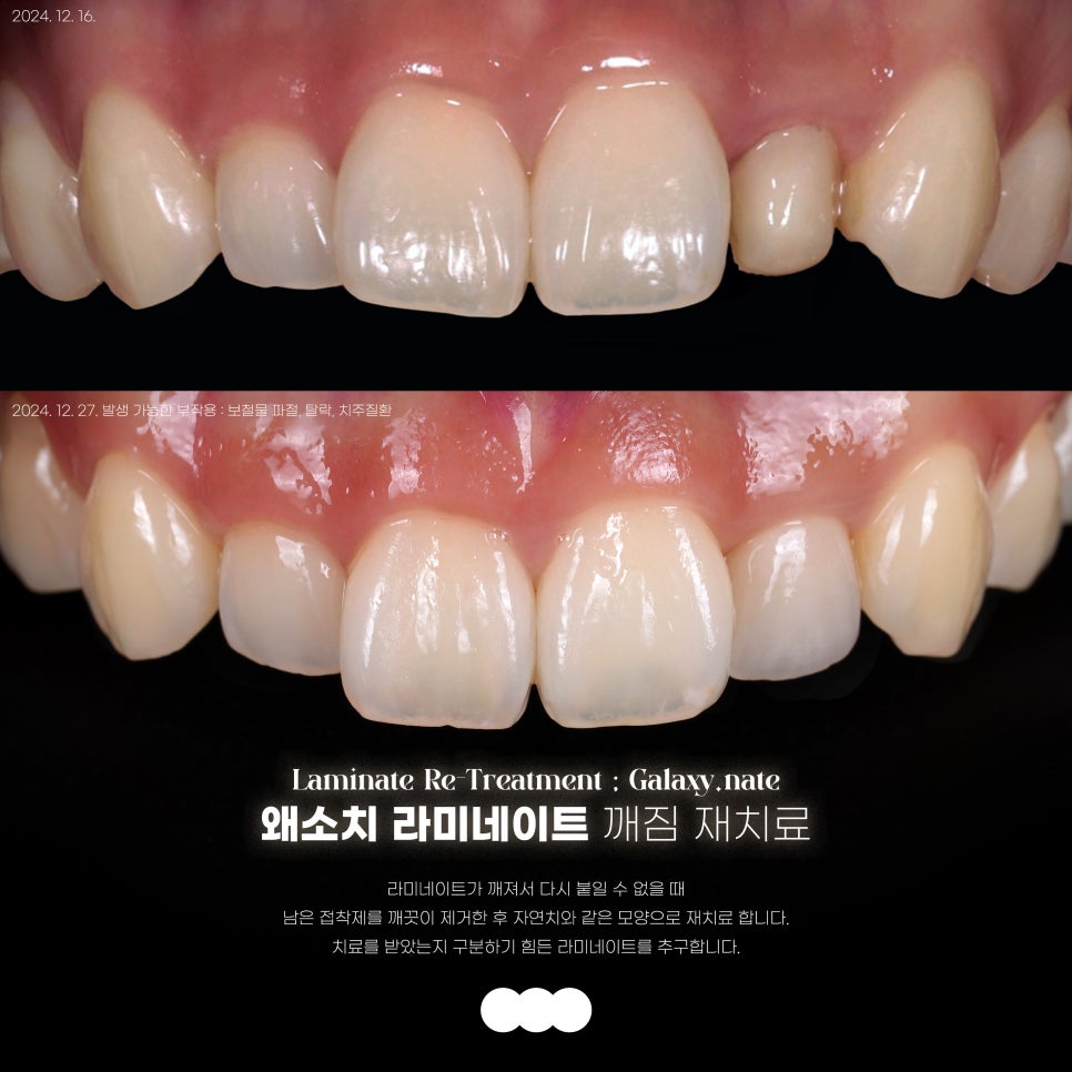 교대역 왜소치 라미네이트, 자연스러운 결과를 위한 고민 관련 이미지 2