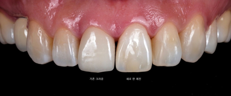 반포동 앞니 크라운, 레진 교체로 인상이 바뀐 후기 관련 이미지 3