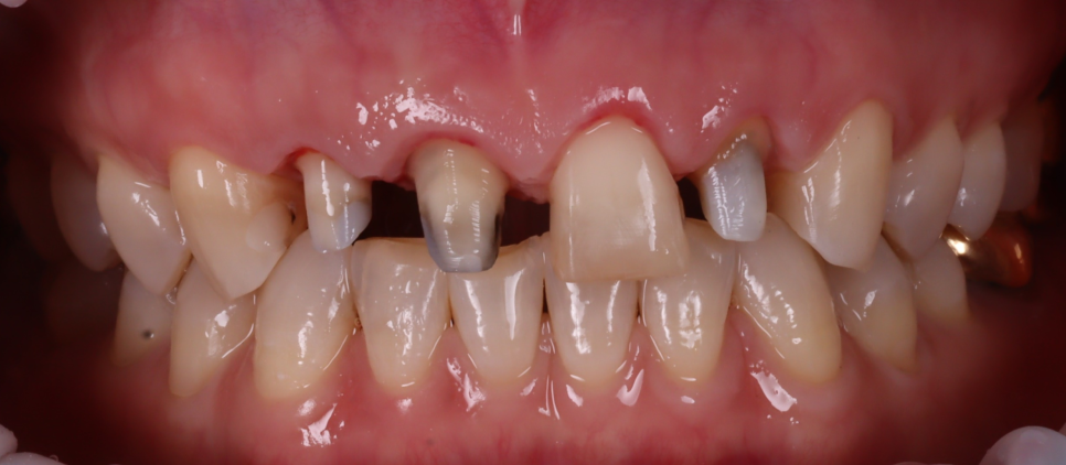 라미네이트, 크라운 재치료, 잇몸 성형까지 앞니 6개 치료 관련 이미지 10