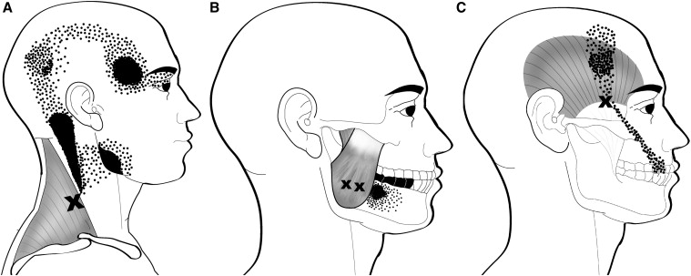 '까드득' 이갈이에 잠 못 이룬 밤, 편안한 수면을 위한 이갈이 장치 관련 이미지 1