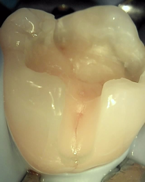 인레이치료 하방 2차 충치 레진 빌드업 사례 관련 이미지 11