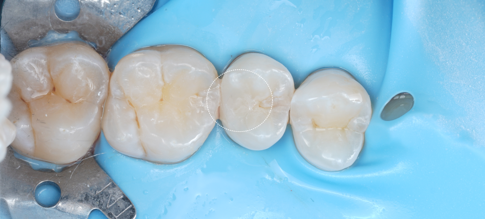 서초역치과 이걸로 신경치료 미뤄드리고 있어요 관련 이미지 12