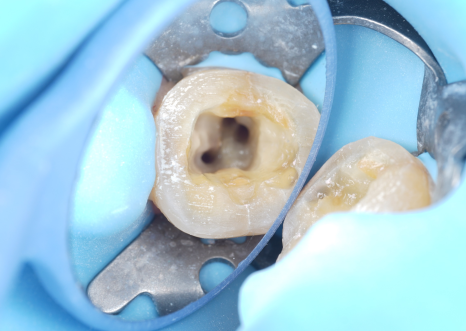 Gangnam Dental Clinic: You Wanted an Extraction, but We Preserved the Tooth with Root Canal Treatment + Overlay image 13