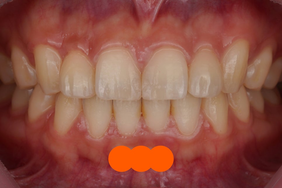 서초/강남 왜소치 레진 비니어, 당일 치료해주는 치과 Direct Composite Veneer in Korea 관련 이미지 3